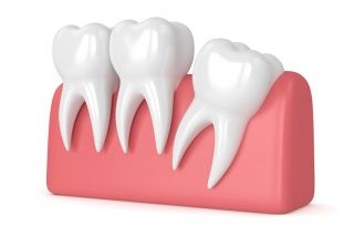 Wisdom teeth