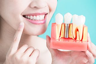 Dental Implants